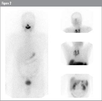 Iodine-131 - UW-L Brachy Course Iodine-131 - UW-L Brachy Course