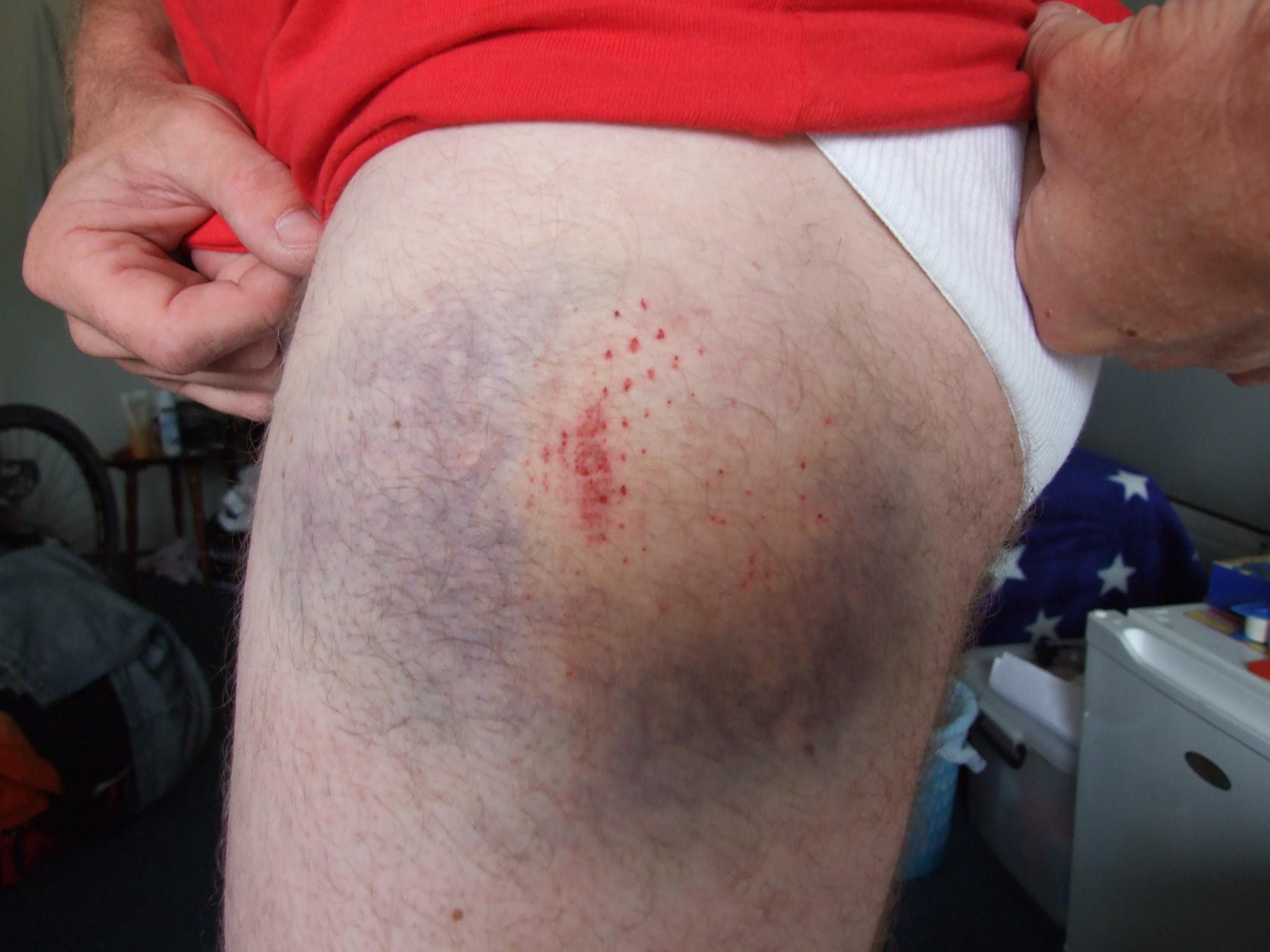 nice bruise thanks to rangiora nice bruise thanks to rangiora