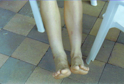 Steve Ewart Broken Ankle no2. Steve Ewart Broken Ankle no2.